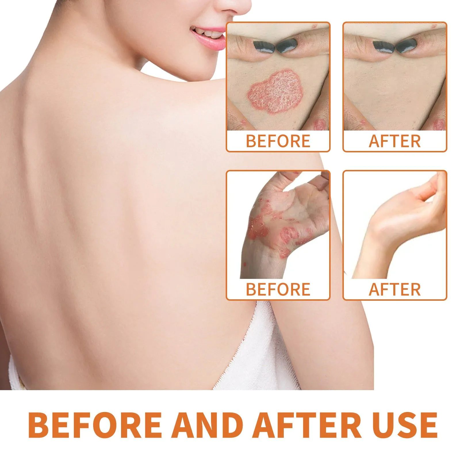image-WIYUN Bee Venom Psoriasis Cream - Moisturizing