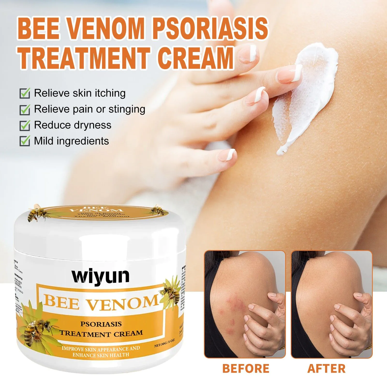 image-WIYUN Bee Venom Psoriasis Cream - Moisturizing